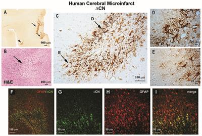 Astrocyte Activation and the Calcineurin/NFAT Pathway in Cerebrovascular Disease